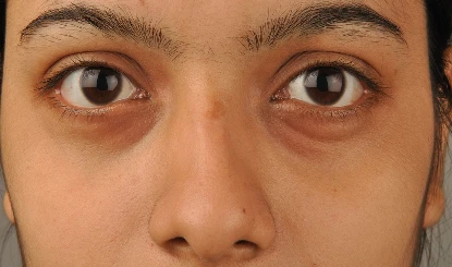 Beauty Tips: थकी हुई आंखों को बनाएं Bright और Hydrated, Under Eye Patches से पाएं फ्रेश लुक