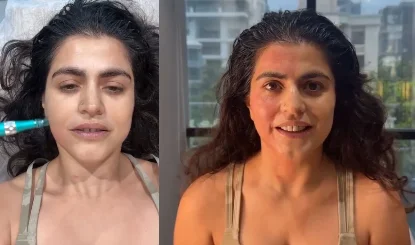 डरावने लुक के बाद मिलता है तुरंत Glow? Shenaz Treasury ने बताया Vampire Facial का सच